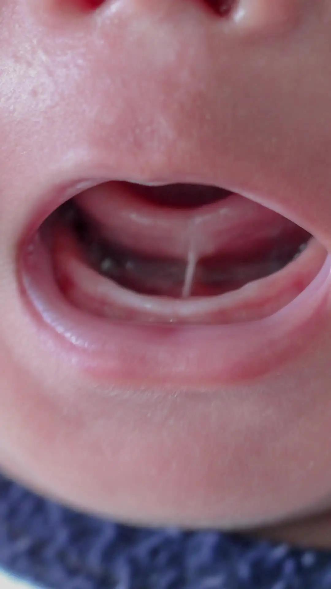 Kapan Perlu Memotong Tongue Tie