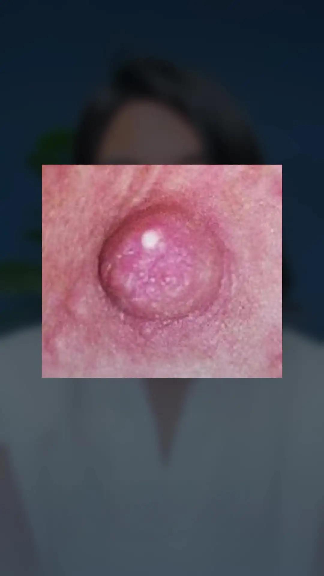 Nipple Blister